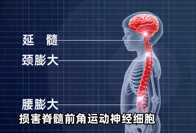 同筑健康防线丨脊髓灰质炎：吞噬无数儿童的“隐形猛兽”是如何被终结的